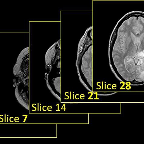 mri slice thickness test|slice thickness brain metastatic.